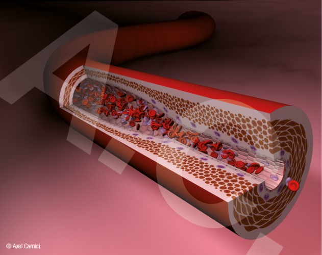 Illustriertes Standbild aus einer Animation über arterielle Stenose.