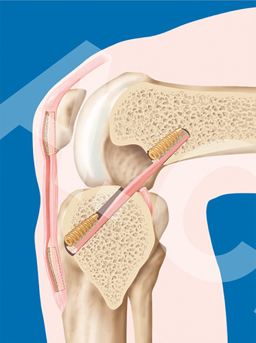 Illustrative Darstellung einer Kniegelenkskorrektur durch Einsetzen eines Kreuzbandimplantates.
