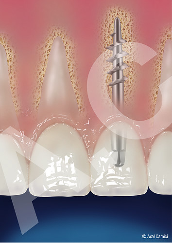Medizinische Illustration, wie ein Zahnimplantat im menschlichen Kiefer platziert wird.