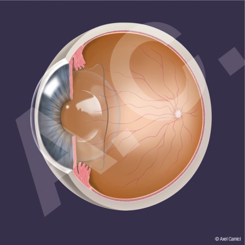 Das Bild zeigt illustrativ, wie eine künstliche Augenlinse im Augapfel eingesetzt wird.