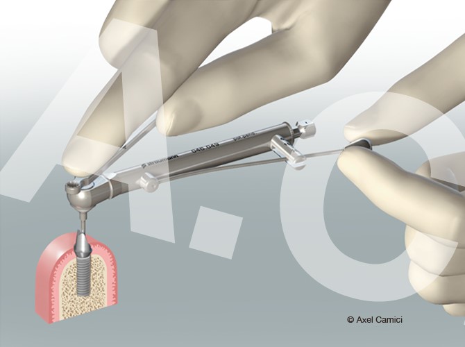 Darstellung eines medizinischen Spezialwerkzeuges für die Zahnimplantation.